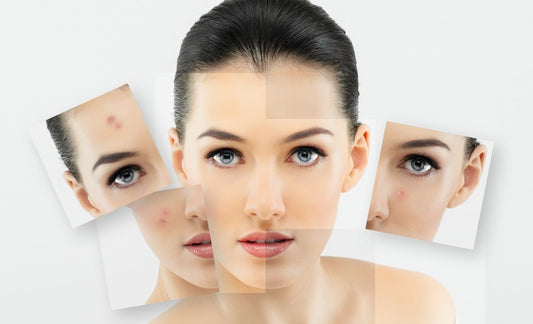 Skincare Tips for Oily Skin
